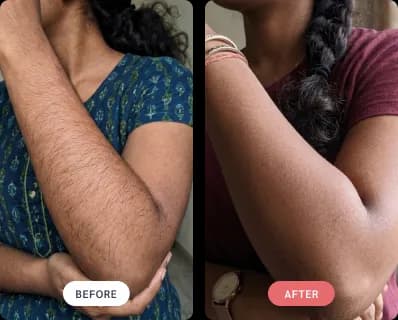 Laser hair removal result — full arms, before and after