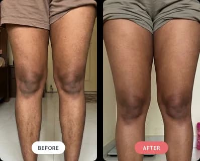 Laser hair removal result — legs, before and after