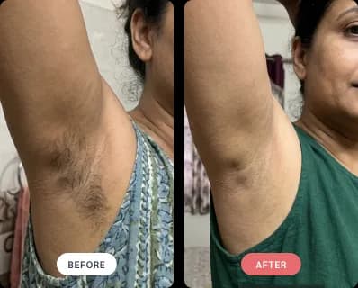 Laser hair removal result — underarms, before and after