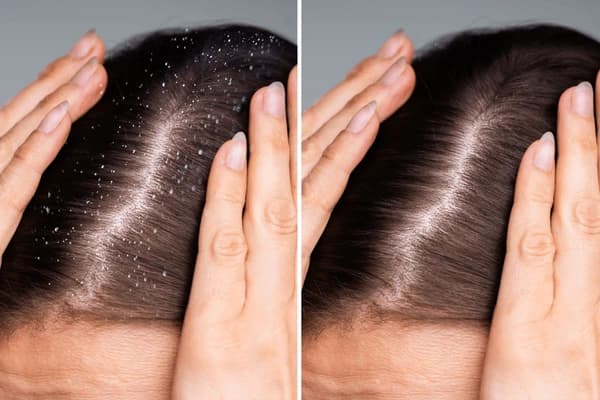 Doctor examining a patient's scalp for dandruff at The Aesthetic Edge
