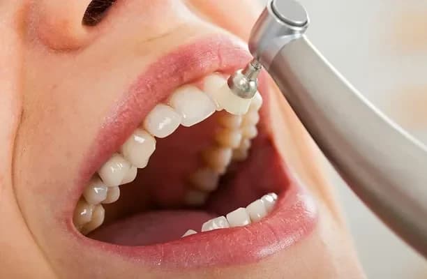 Dental scaling and polishing treatment