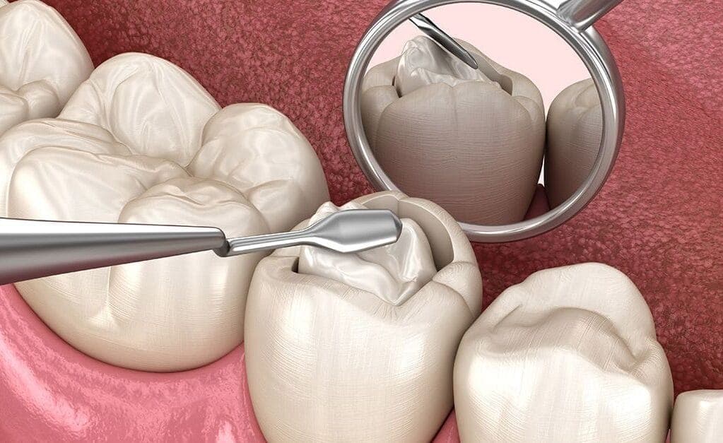 Tooth-coloured dental filling being placed at The Aesthetic Edge, Bangalore