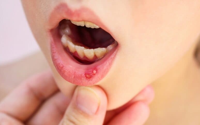 Dental examination for recurrent mouth ulcers at The Aesthetic Edge, Bangalore