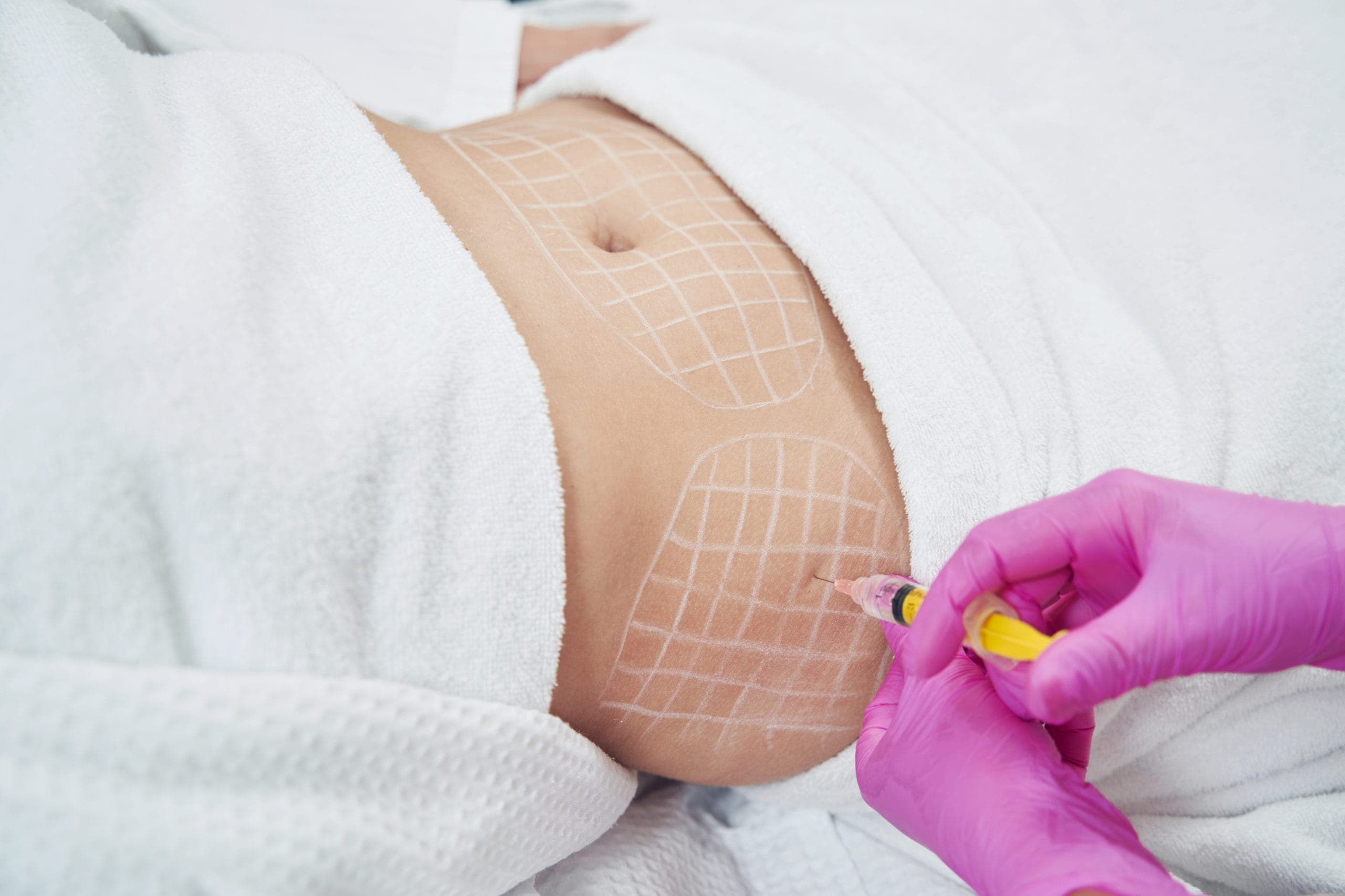 Doctor marking a small treatment area before lipolytic injections at The Aesthetic Edge
