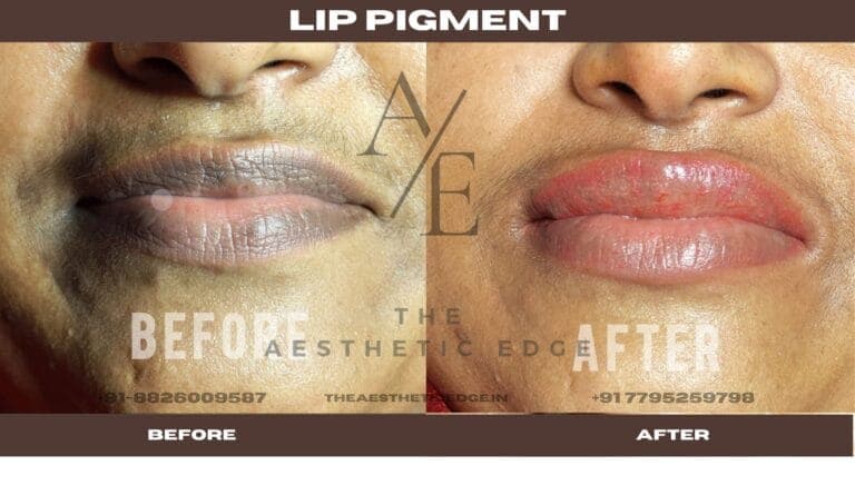 Lip pigment correction before and after
