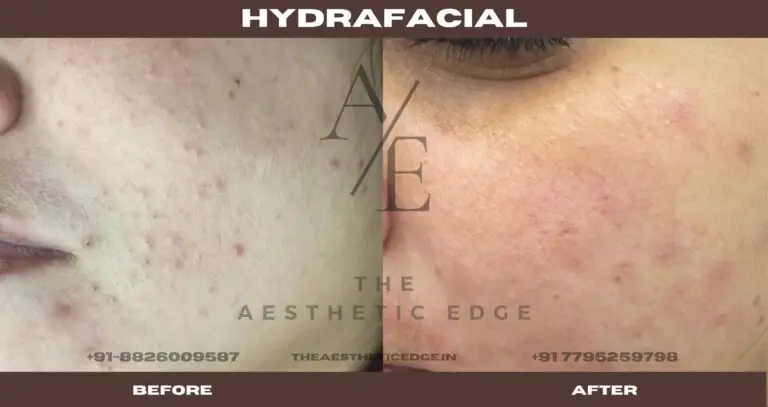 HydraFacial result before and after