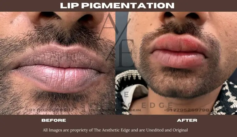 Male lip pigmentation before and after
