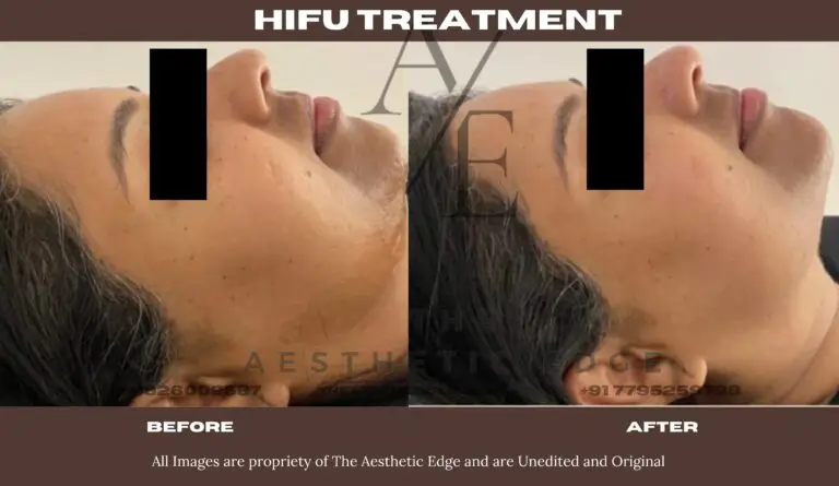 HIFU skin tightening before and after