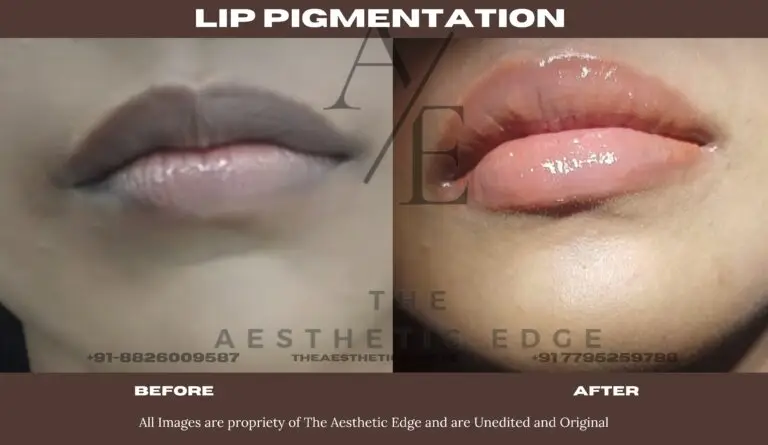 Lip pigmentation treatment before and after
