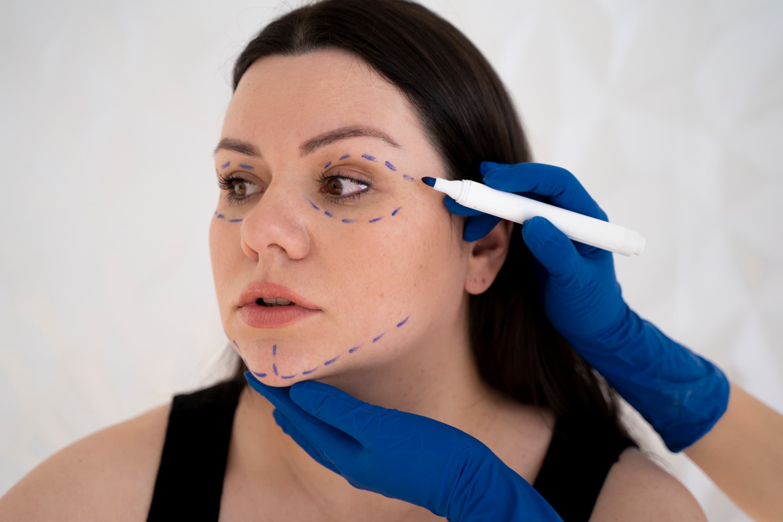 Doctor planning thread placement along a patient's jawline before a thread lift