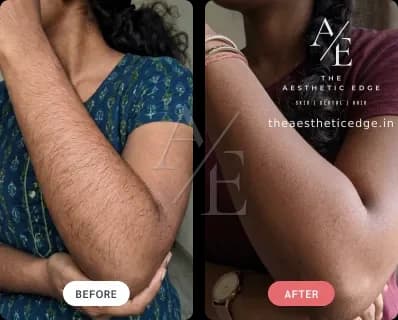 Laser hair removal result — full arms, before and after