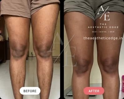 Laser hair removal result — legs, before and after