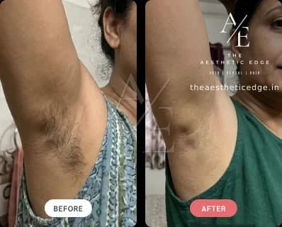 Laser hair removal result — underarms, before and after