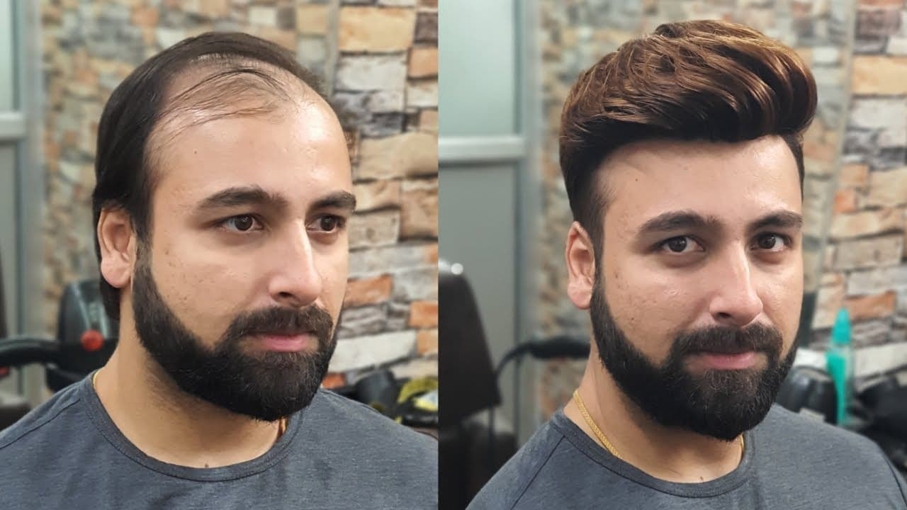 Custom hair patch being matched to a patient's hair colour and density