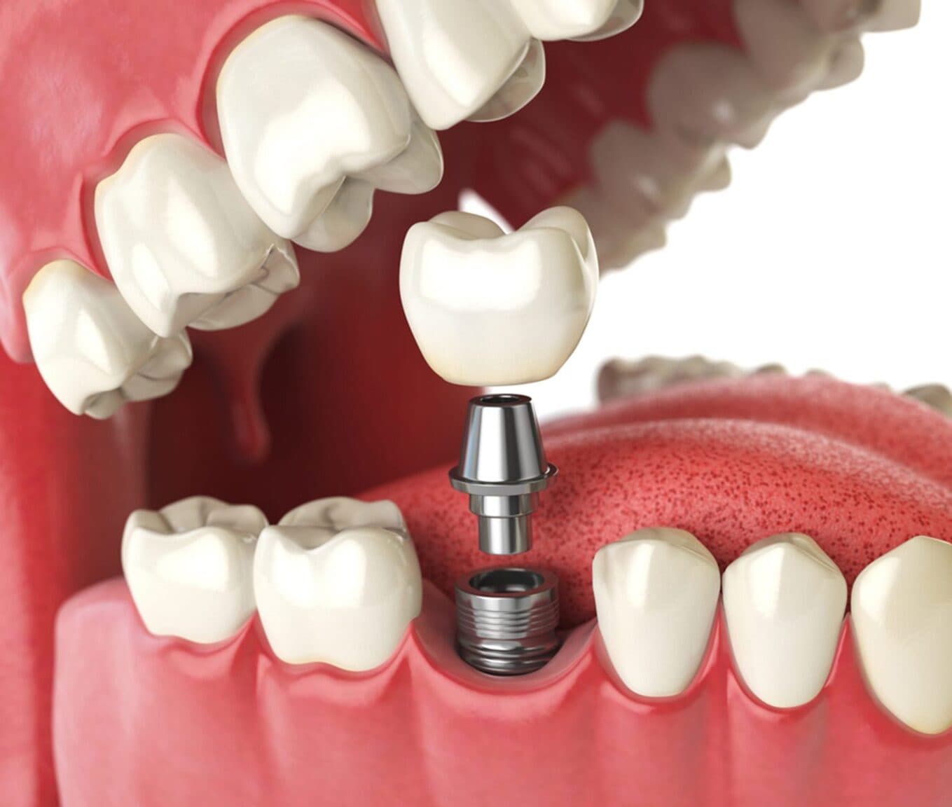 Dental implant consultation at The Aesthetic Edge, Bangalore