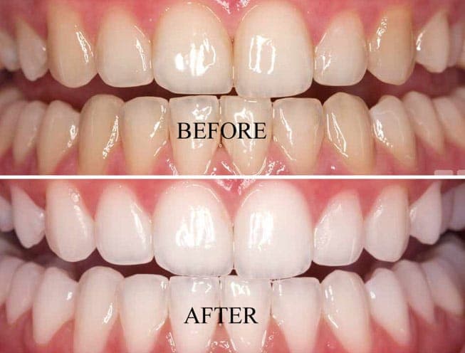 Teeth whitening treatment in progress