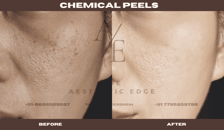 Chemical peel pigmentation result, before and after