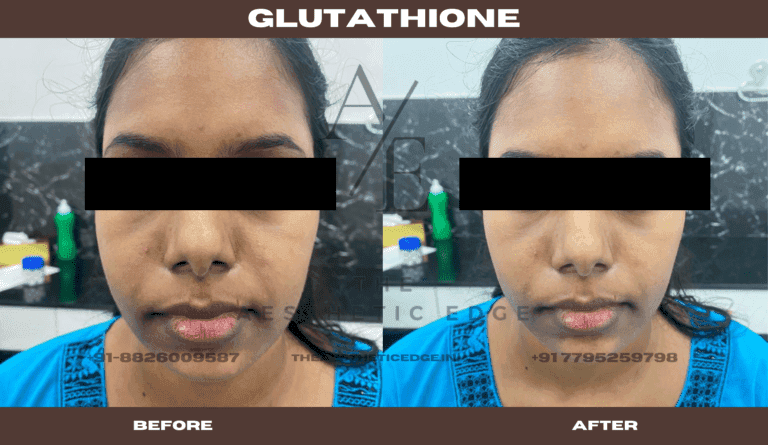 Glutathione skin brightening before and after