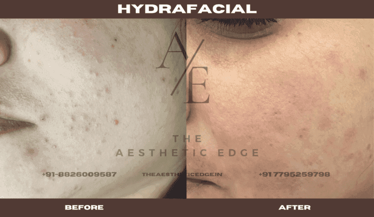 HydraFacial on acne-prone skin, before and after