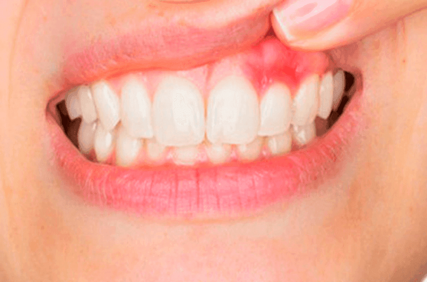 Advanced gum disease treatment at The Aesthetic Edge, Bangalore