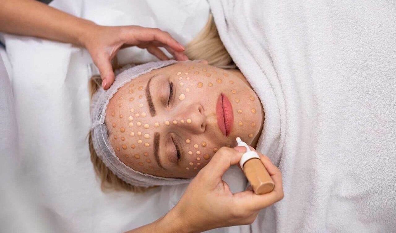 BB Glow microneedling therapy