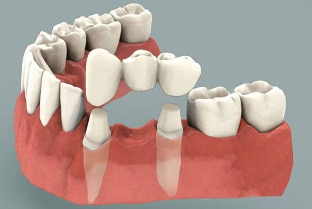 Custom dental crown and bridge work at The Aesthetic Edge, Bangalore