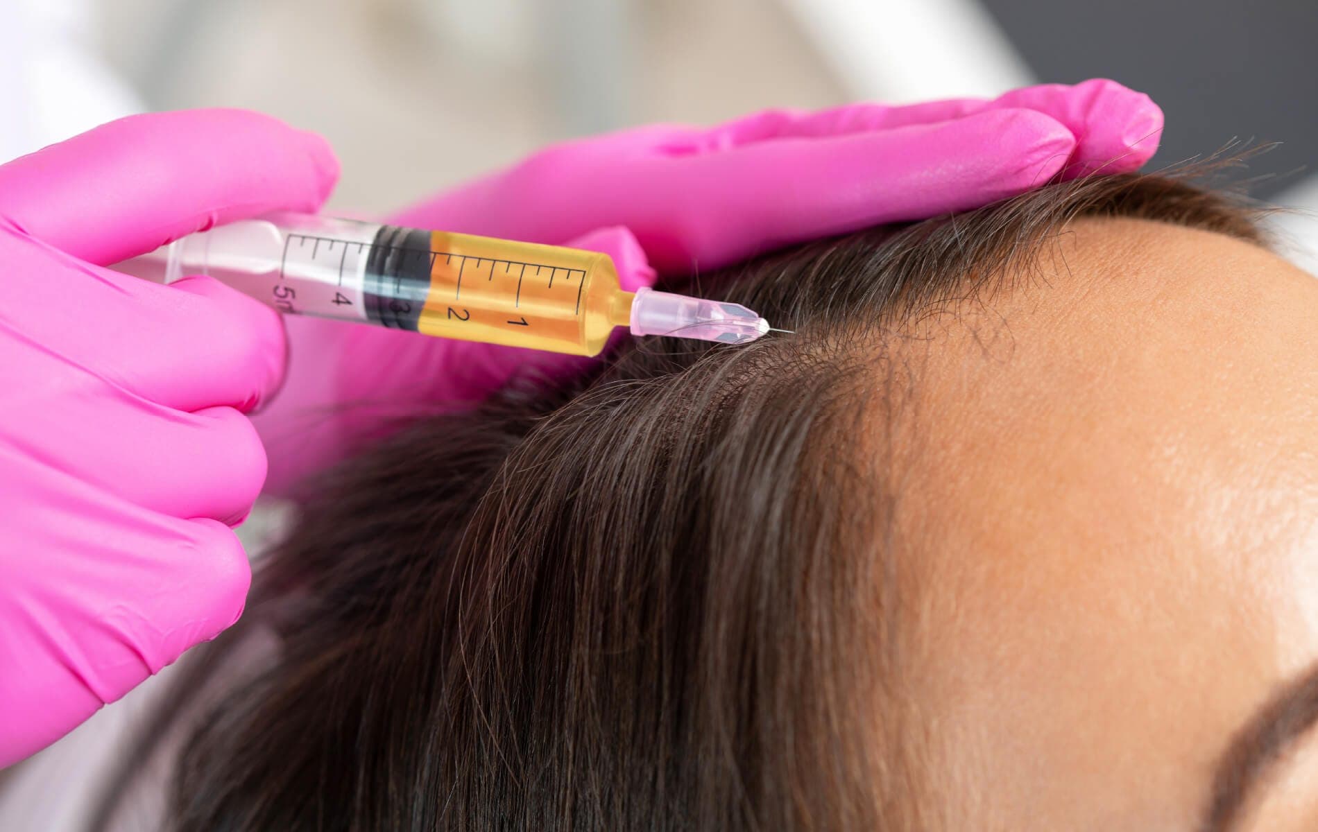 PRP hair regrowth session