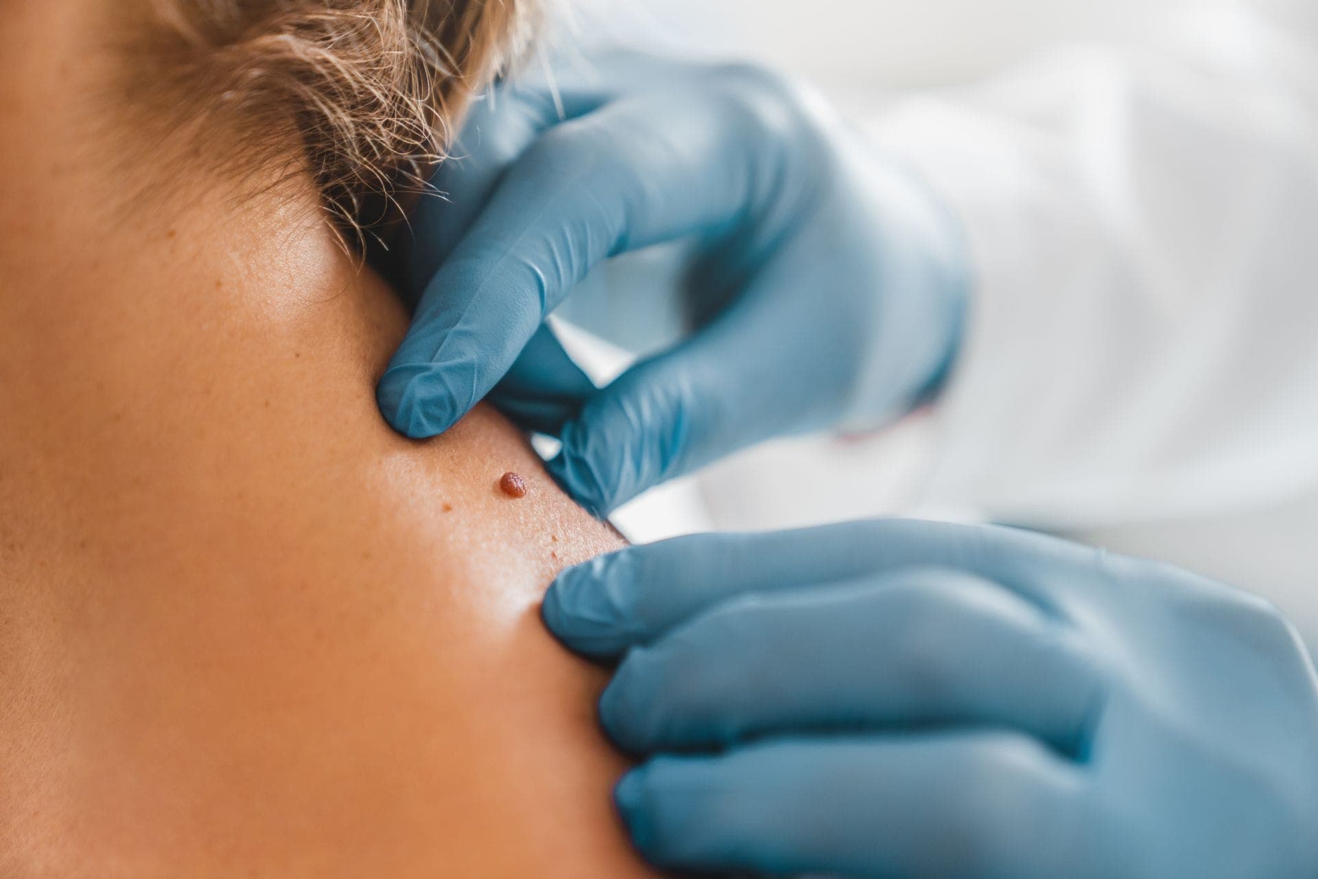 Fine radiofrequency cautery electrode used for precise removal of a small skin lesion
