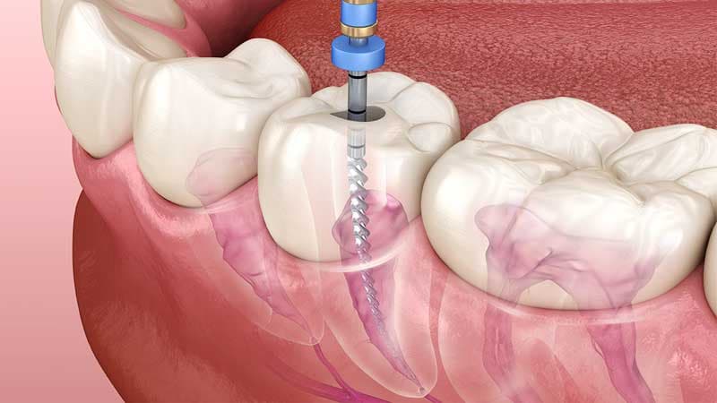 Root canal treatment being carried out at The Aesthetic Edge, Bangalore
