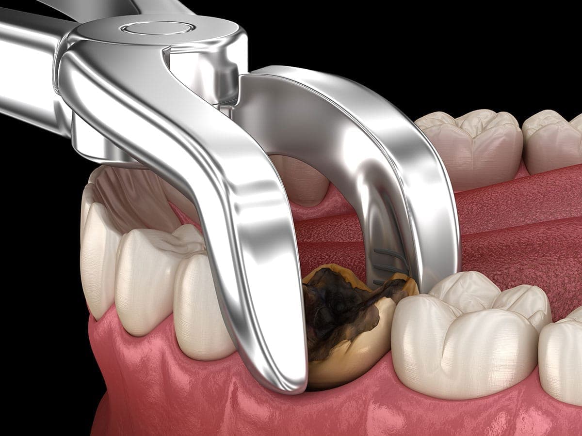 Wisdom tooth X-ray assessment at The Aesthetic Edge, Bangalore