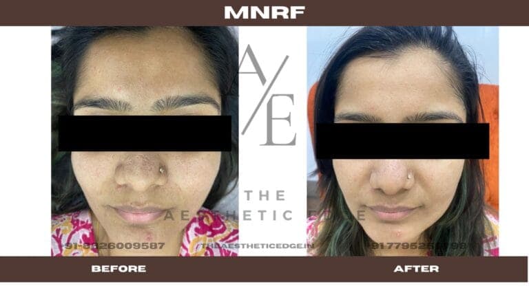 MNRF skin texture result, before and after