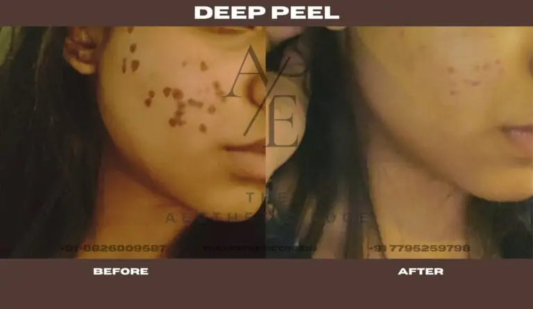 Deep peel before and after