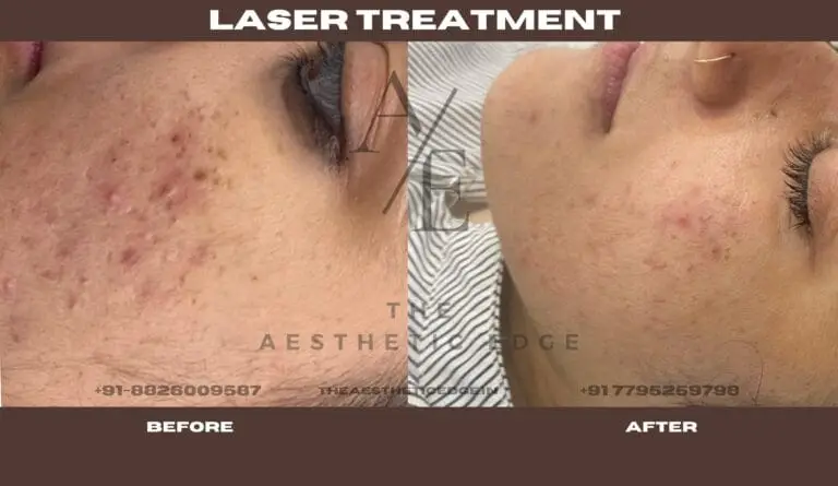 Q-switch laser before and after
