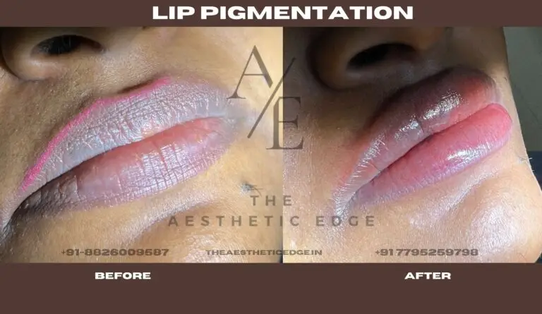Lip pigmentation treatment result at The Aesthetic Edge