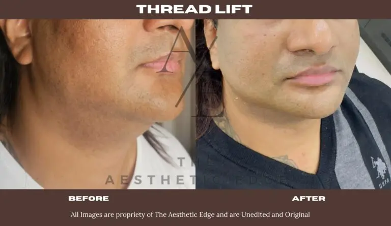 Thread lift result, before and after