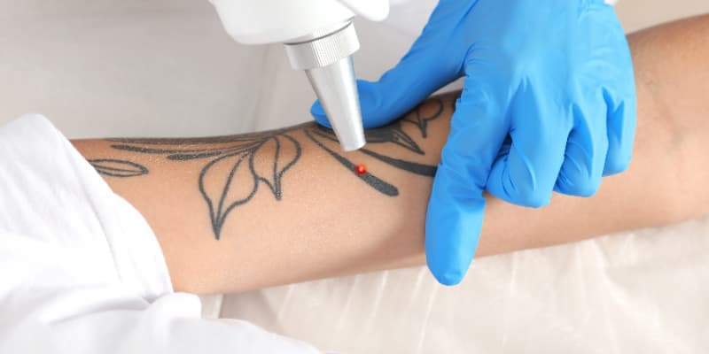 A laser tattoo removal session at The Aesthetic Edge, Bangalore