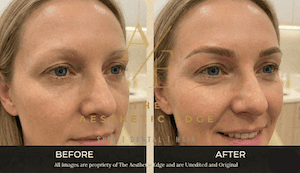 Eyebrow microblading result at The Aesthetic Edge