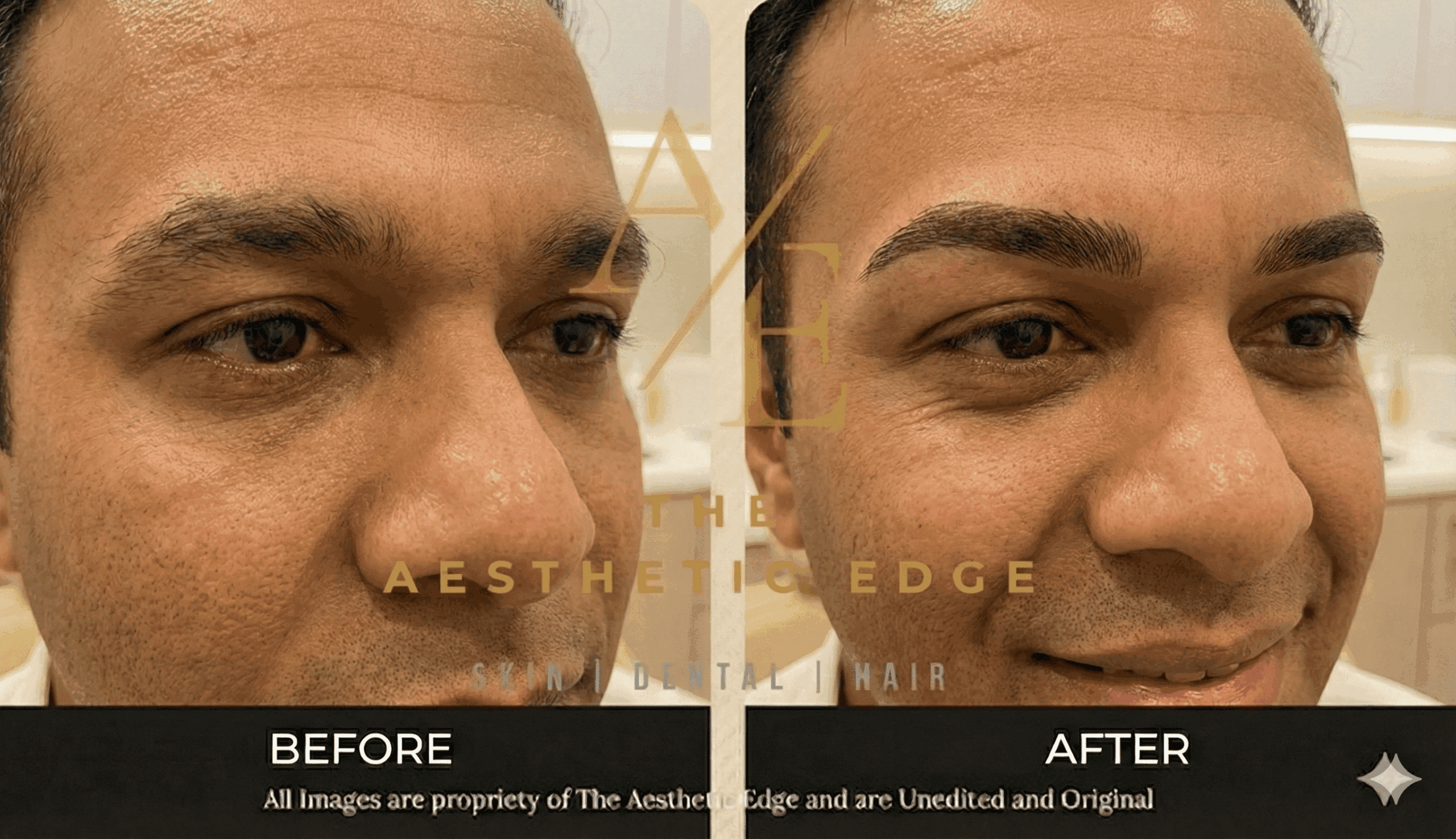 Pigment shades being matched against a patient's skin tone before a semi permanent makeup session