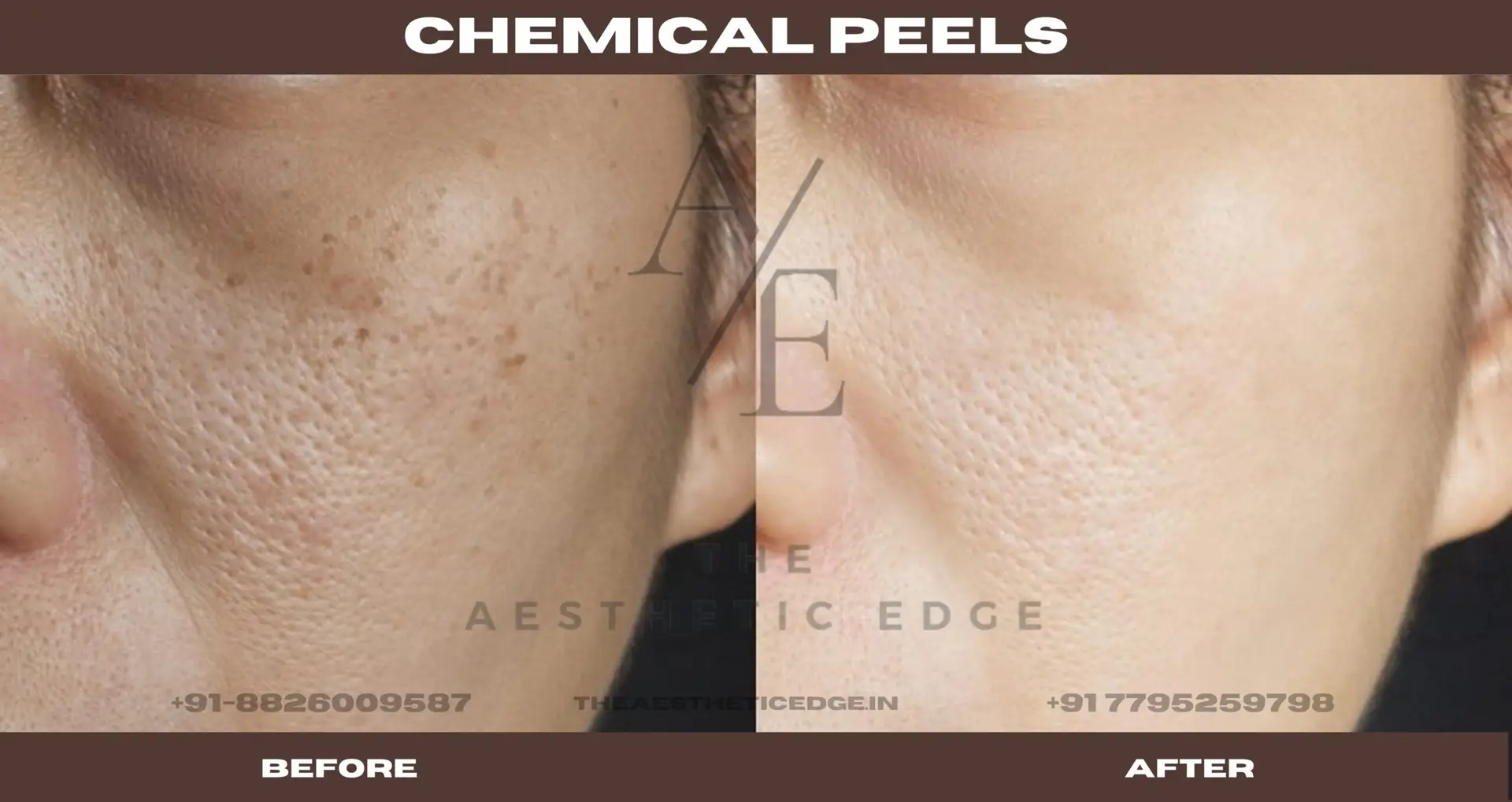 Chemical peel results