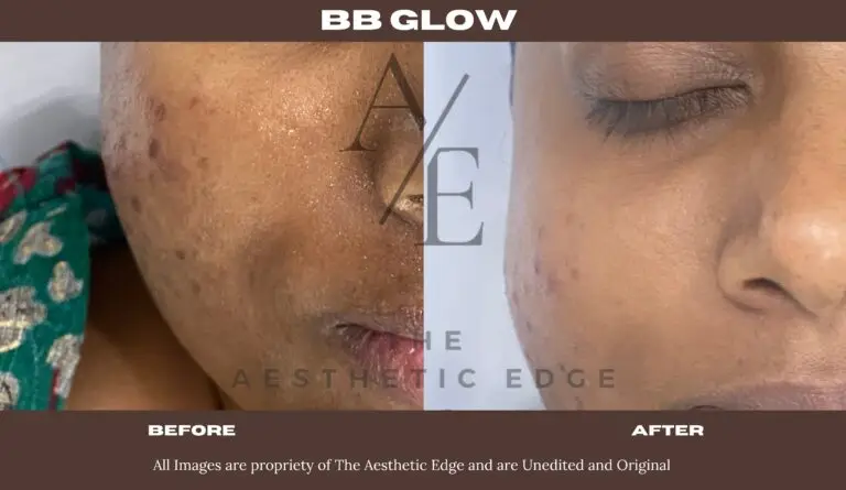 BB glow before after
