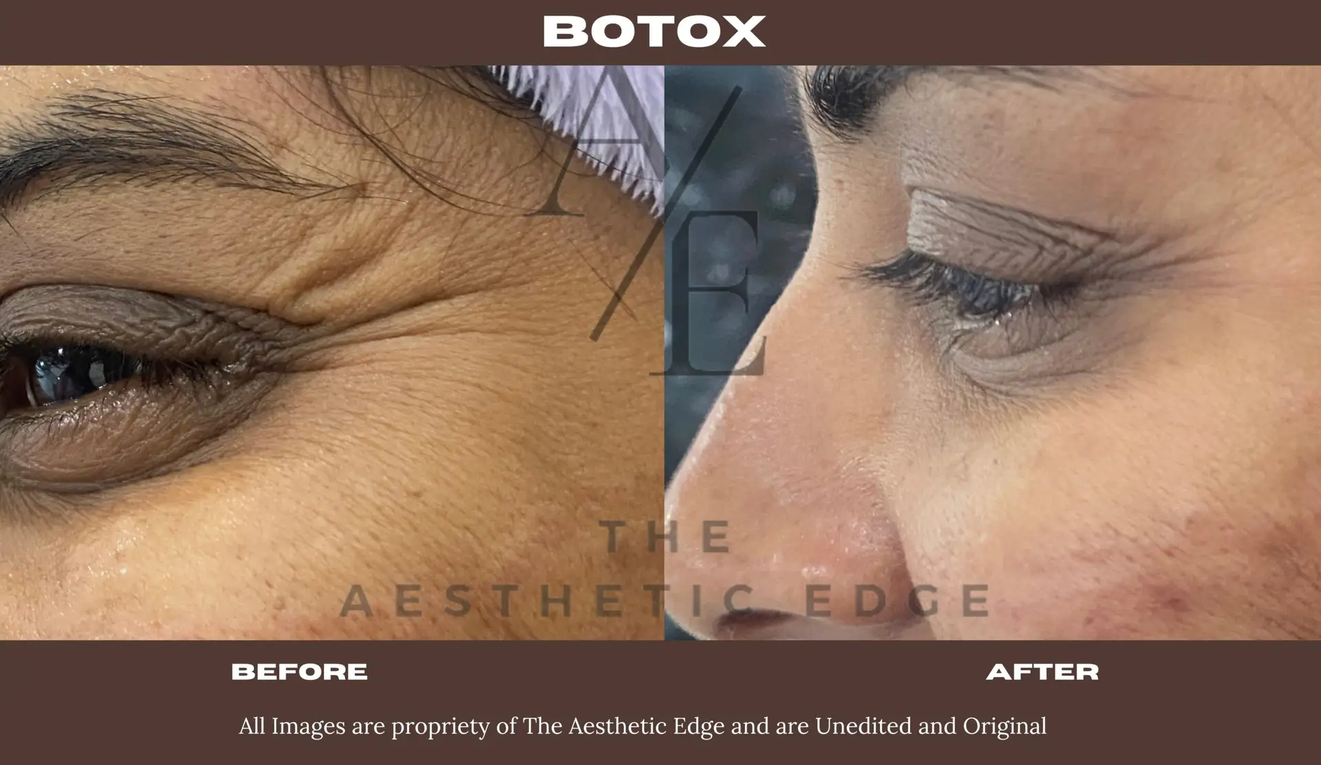Botox before after