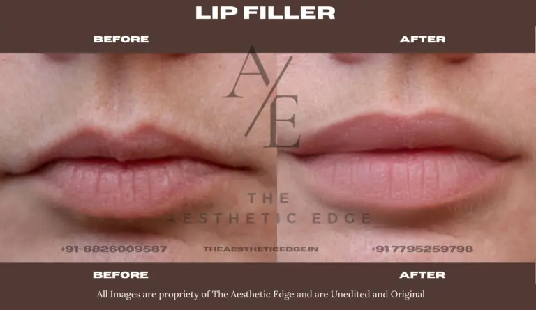 Lip filler before and after