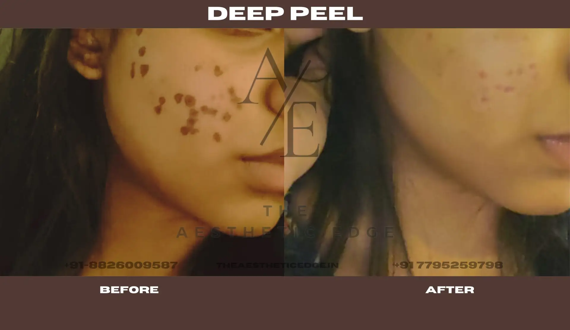 Deep peel results