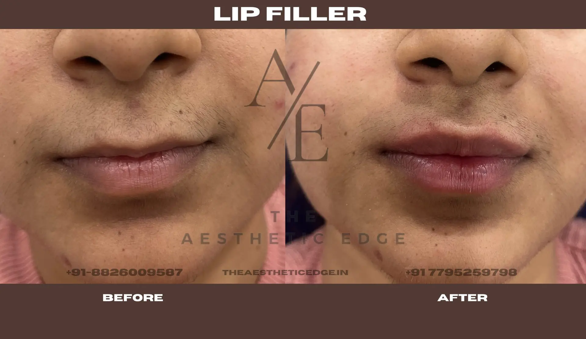Lip filler results