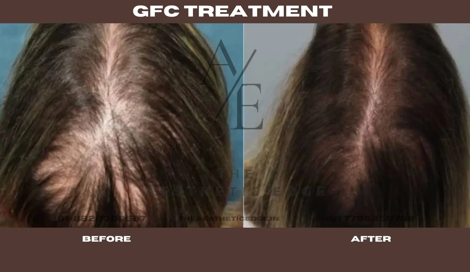 GFC treatment results