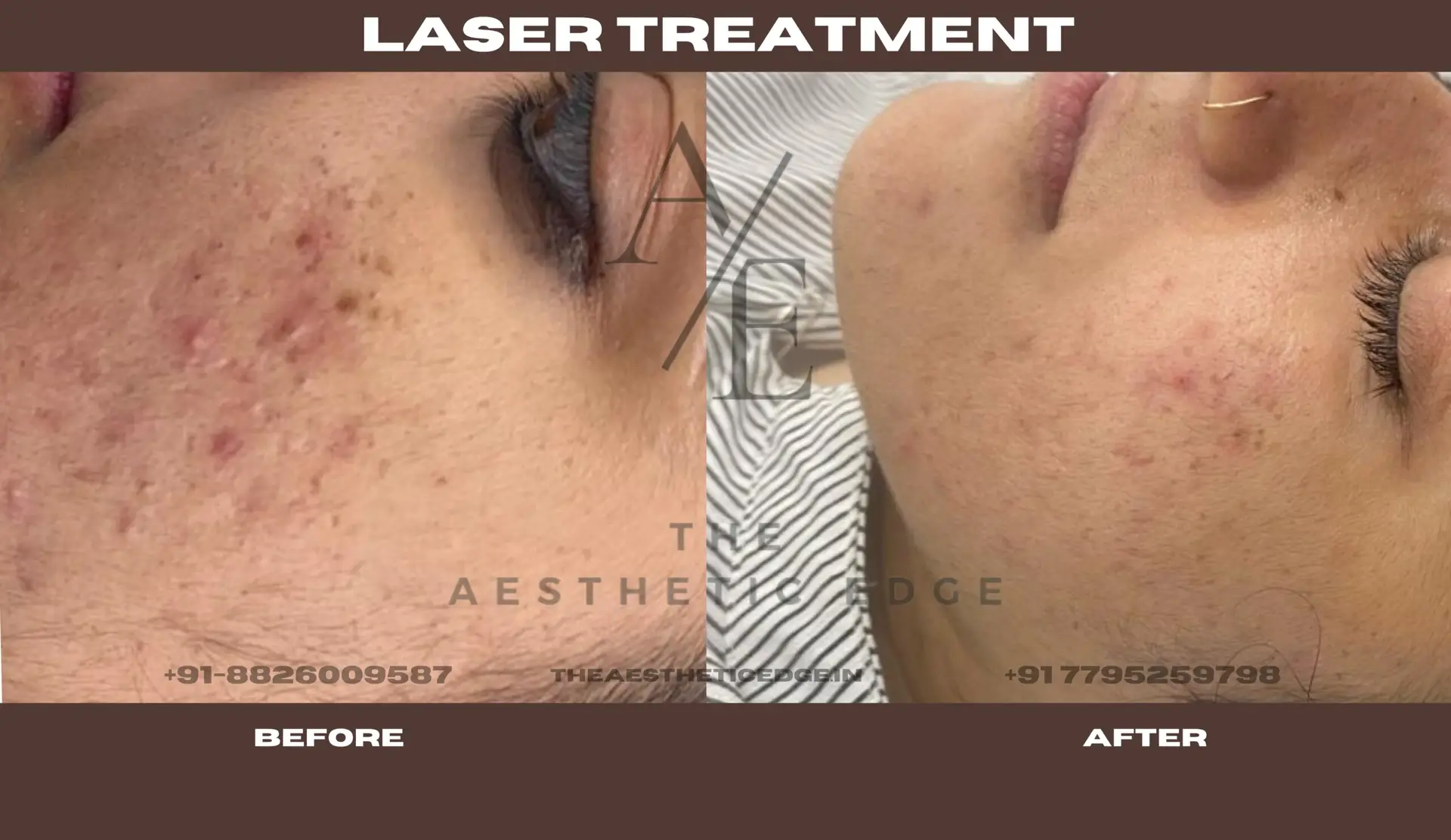 Laser treatment results