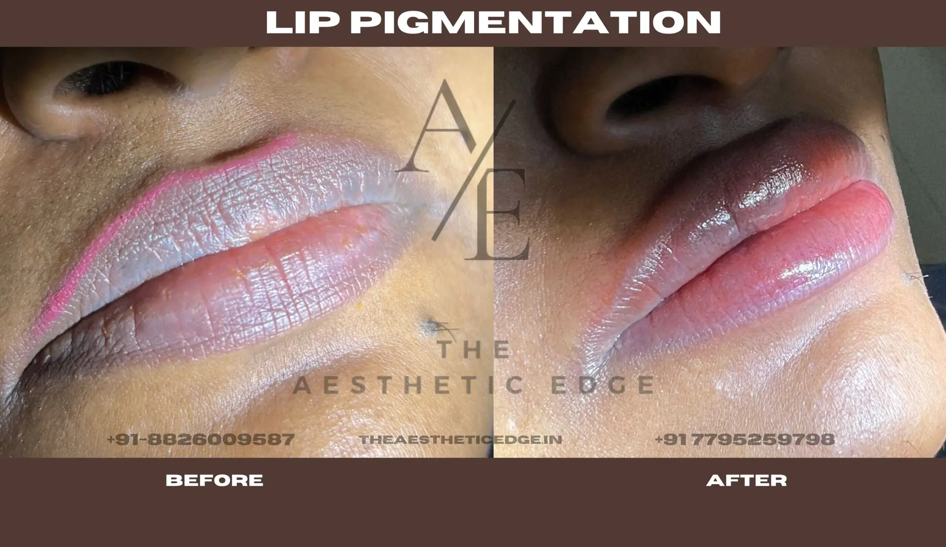 Lip pigmentation results