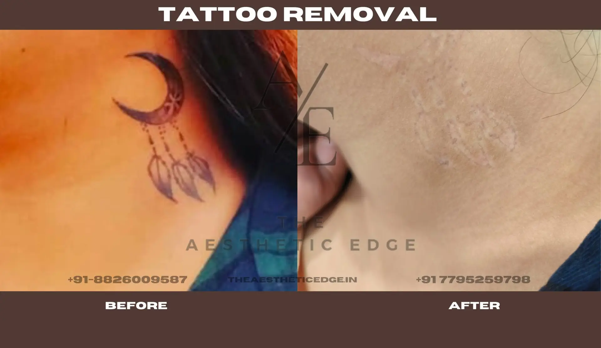 Tattoo removal results