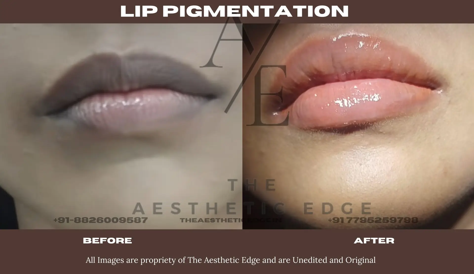 Lip pigmentation - Before After