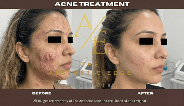 Acne scar before after
